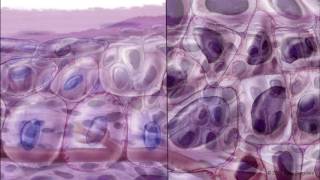 Progression of Conjunctival Intraepithelial Neoplasia [upl. by Otilia886]