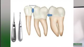 How to make molar extractions easier [upl. by Friday920]