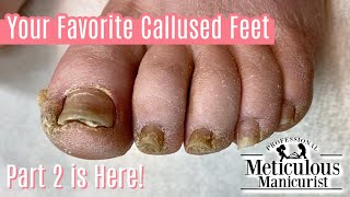 Extremely Callused Feet How to Pedicure  Left Foot [upl. by Anairdna]