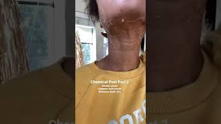 Chemical Peel Part 2 shorts [upl. by Mintz]