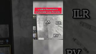 Leadless Pacemaker amp Implantable Loop Recorder on fluoroscopy heart Cardiology [upl. by Leaffar]