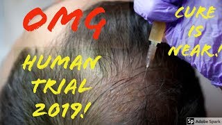 OMG HUMAN CLINICAL TRIALS TO CURE BALDNESS Dr Takashi Tsuji UPDATE [upl. by Petit]