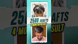 2500 Grafts Hair Transplant  4 Months Result hairtransplant hair shorts ytshorts [upl. by Lethia731]