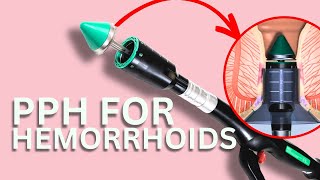 PPH hemorrhoid surgery  Dr Chung explains [upl. by Ahsital49]