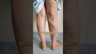 Can You Really Get Rid of Varicose Veins in Just 24 Hours [upl. by Ylremik801]