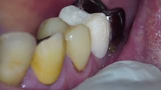 Create a temporary crown on the upper right premolar [upl. by Nylirem141]