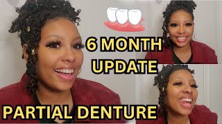 Partial Denture Update  6 MONTHS LATER  Do I still want a dental implant [upl. by Aikym363]