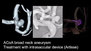 Aneurysm ACoa  Artisse [upl. by Jules]