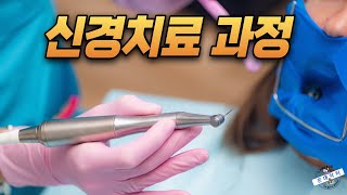 신경치료 과정 통증 해결부터 크라운 보철까지 기간 및 내원횟수 [upl. by Ysak]