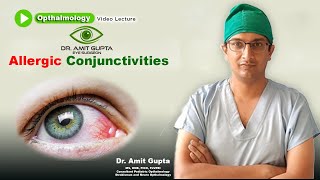 Allergic conjunctivitis  Ophthalmology  Signs and Symptoms  Diagnosis and Treatment [upl. by Anivlac]