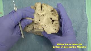 Coronal forebrain first videoneuroanatomy forebrainhypothalamushumanbrainbrainhumanbrain [upl. by Mauldon]