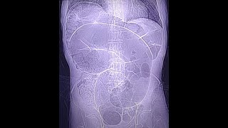 Sigmoid volvulus  typical case CT findings [upl. by Luht]