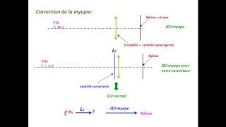 Comment corriger les défauts de l’œil  exercice corrigé en optique [upl. by Hootman89]