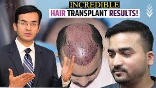 Incredible Hair Transplant Results in India at Medispa India by Dr Suneet Soni [upl. by Zoila]