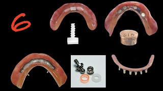 6 tipos de dentaduras apoiadas sobre implantes Overdentures [upl. by Gabbey]