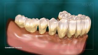 Periodontitis  Gum Disease [upl. by Eyeleen89]