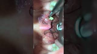 Tonsil stone removal Ropa z migdała [upl. by Ailene]