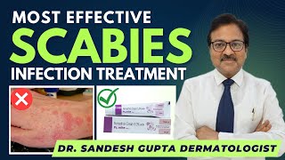 Scabies Treatment Dr Sandesh Gupta Dermatologist Delhi9990804089 [upl. by Anoyek503]