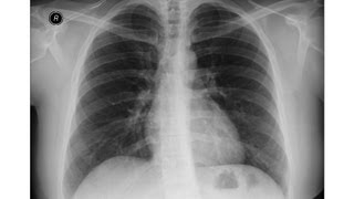 Chest xray  Asbestosis  Pleural calcifications  Round atelectasis [upl. by Joses854]