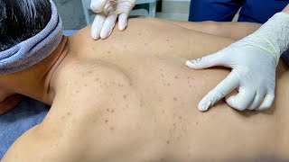 ACNE TREATMENT VU QUYNH MI Blackheads On Boy Back 2024 [upl. by Ahsienet]