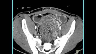 Abdomen Small Bowel EnteritisSeries of coronal sagittal volume rendered and MIP images4 of 6 [upl. by Ayifas741]