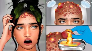 ASMR Head Acne Removal and Pimples Popping  Itchy Scalp Treatment ASMR [upl. by Ttej]