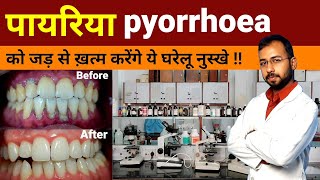 Pyorrhea ka gharelu ilaj  pyorrhea treatment at home  Periodontitis Treatment  pyorrhea symptoms [upl. by Ellednek]