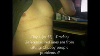 Tinea Versicolor Treatment  Learn How To Cure Tinea Versicolor In 2 Weeks [upl. by Kali]