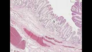 Histopathology ColonTubular adenoma adenomatous polyp [upl. by Icram]