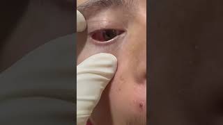 Conjuntivitis infección de los ojos [upl. by Alvie108]