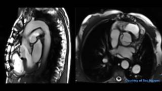 Aortic valve stenosis and regurgitation  Siemens 15T AERA [upl. by Everrs215]