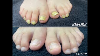 Laser Fungal Nail treatment in 8 year old boy Part 2 [upl. by Taam]