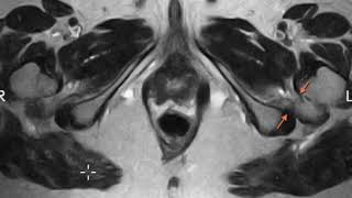 Ischiofemoral impingement [upl. by Yanffit]