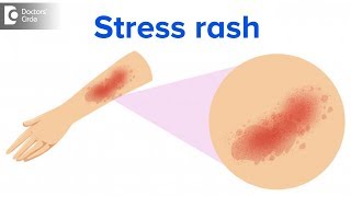 What is a stress rash  Dr Rajdeep Mysore [upl. by Lyda]