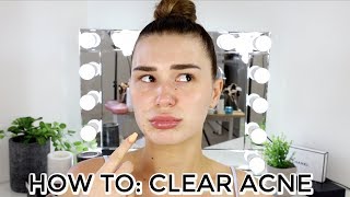 HOW TO CLEAR ACNE ON THE HOLIDAYS  Shani Grimmond [upl. by Ocsinarf]