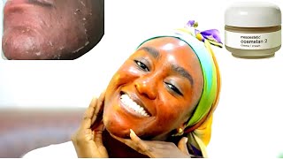 COSMELAN PEEL on Black Skin for Hyperpigmentation and Acne Scars  Full Peeling Process  Review [upl. by Sommers]