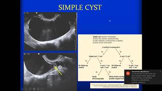 International Cancer Imaging Society Course Oct 17 Incidental adnexal masses Gabriele Masselli [upl. by Ilajna]