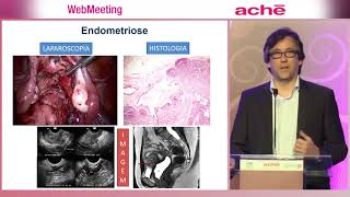 AULA 1 DIAGNÓSTICO E TRATAMENTO DE ENDOMETRIOSE [upl. by Aneral]