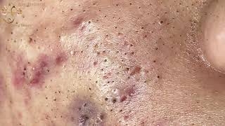 Blackheads Extraction Whiteheads Removal Pimple Popping 2 [upl. by Sinegold]