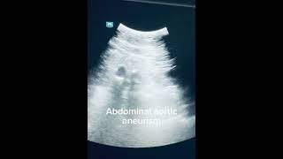 Abdominal aortic aneurism with intraluminal hematoma echocardiography ultrasound cardiacimaging [upl. by Eniamor]