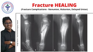 Fracture Healing  Lecture 10  Orthopedics [upl. by Odnalra]