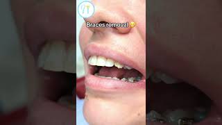 Braces Removal process🦷😬 braces bracesoff dentist teeth [upl. by Nahpos742]