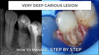 Subgingival Class V We need absolute dam isolation gingivectomy teflon and endodontics [upl. by Kciremed212]