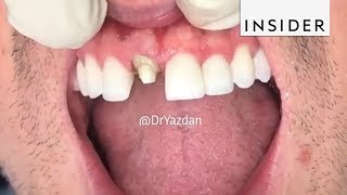 How Dentists Create Tooth Veneers And Crowns [upl. by Asiluj54]