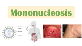 Infectious Mononucleosis Mono  EpsteinBarr Virus Transmission Symptoms Diagnosis Treatment [upl. by Yrad437]