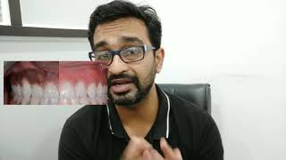 LEUKOPLAKIA SIDE EFFECTS OF LASER TREATMENT जानिए लेज़र के नुकसान OSMF [upl. by Azne995]