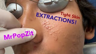 Tight skin acne extractions Comedonal acne with some inflammatory nodules Great session must see [upl. by Hollister]