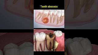 Tooth abscess problem dentist dentisty teeth dental [upl. by Alomeda607]