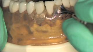 Gingivectomy 2012 [upl. by Itida409]