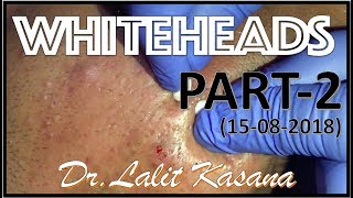 ANTI ACNE TREATMENT PART2 BY DRLALIT KASANA15082018 [upl. by Zetana]